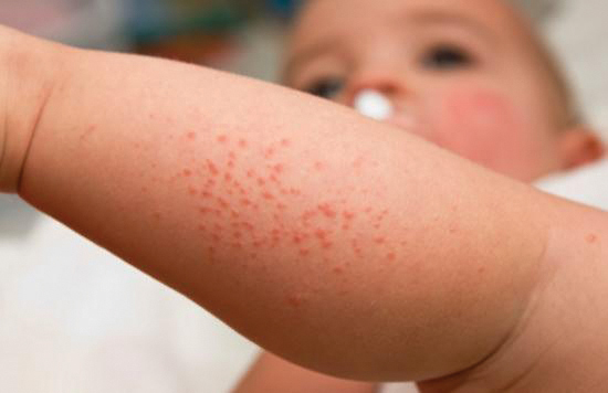 【濕疹】研究：多吸收維他命D 助紓濕疹童病情